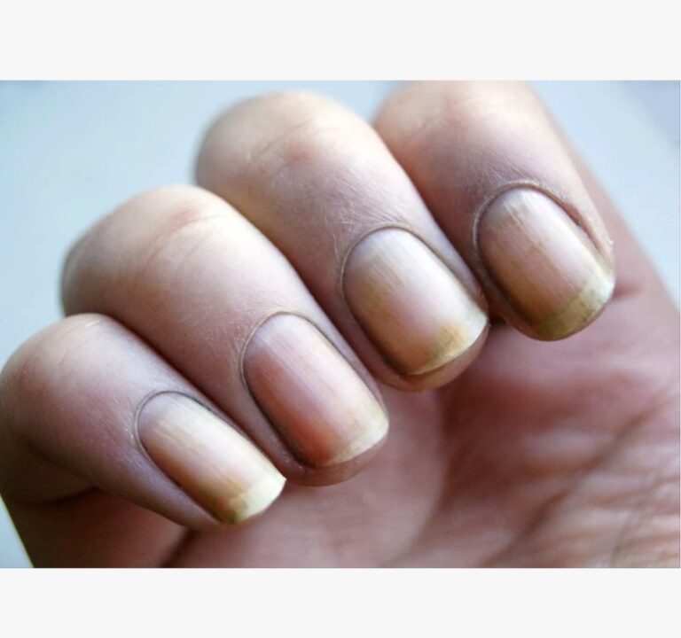 Hongo en las uñas: guía completa sobre la onicomicosis